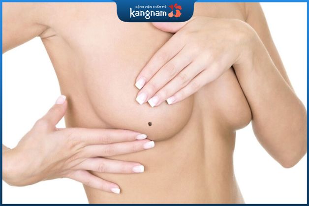 Nốt ruồi dưới bầu ngực