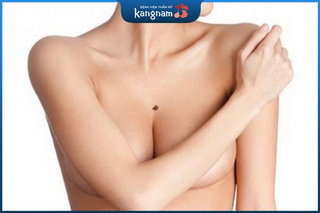 Nốt ruồi ở giữa ngực phụ nữ