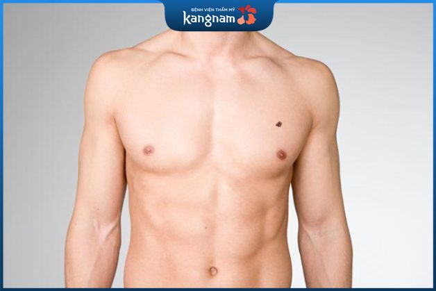 Nốt ruồi trên ngực trái