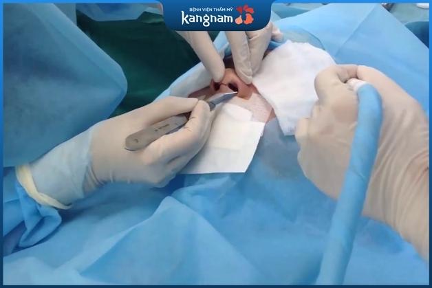 Phẫu thuật làm gọn cánh mũi diễn ra tương đối nhanh