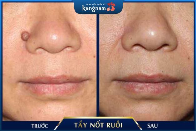 Tẩy nốt ruồi tại Kangnam, xóa bỏ ngay nét kém duyên