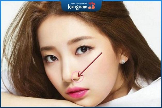 Thu nhỏ cánh mũi có ảnh hưởng gì không?