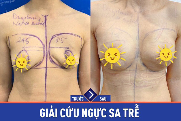 Kết quả khách hàng treo sa trễ kết hợp đặt túi độn