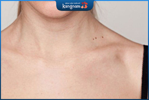 Người sở hữu 3 nốt ruồi ở cổ có số lận đận