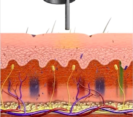 co the xoa xam muc do duoc hay khong2
