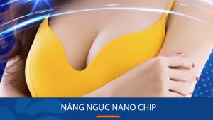 Nâng ngực Nano Chip