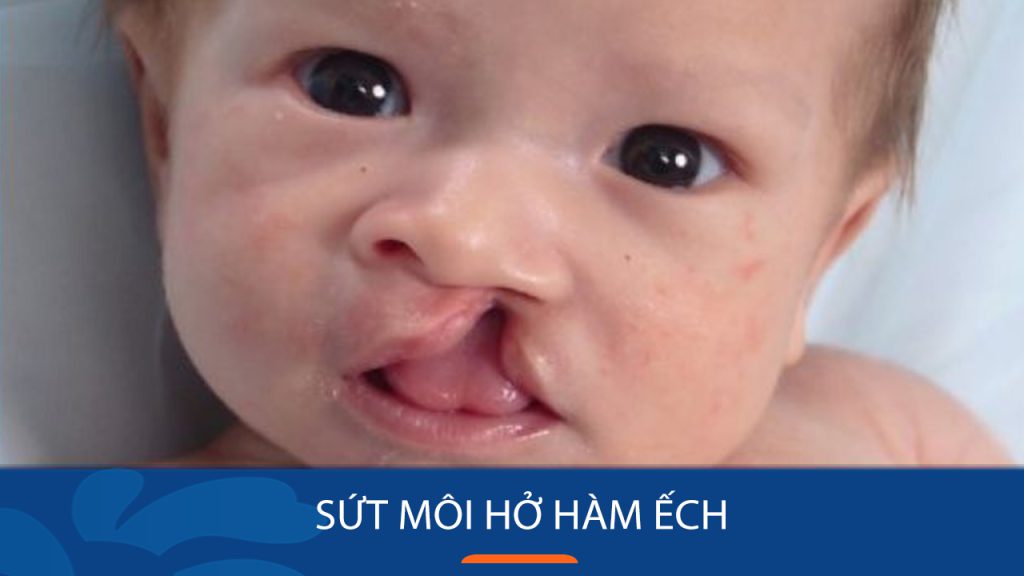 Sứt môi hở hàm ếch: Nguyên nhân, triệu chứng và cách điều trị