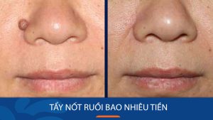 Tẩy nốt ruồi Kangnam giá bao nhiêu? Bảng giá cập nhật mới nhất