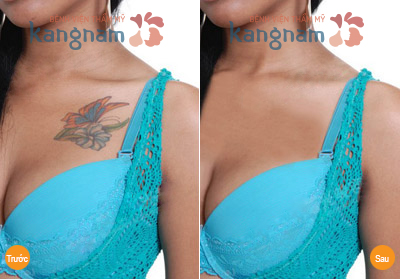 Laser Toning Plus xóa xăm an toàn mọi khu vực