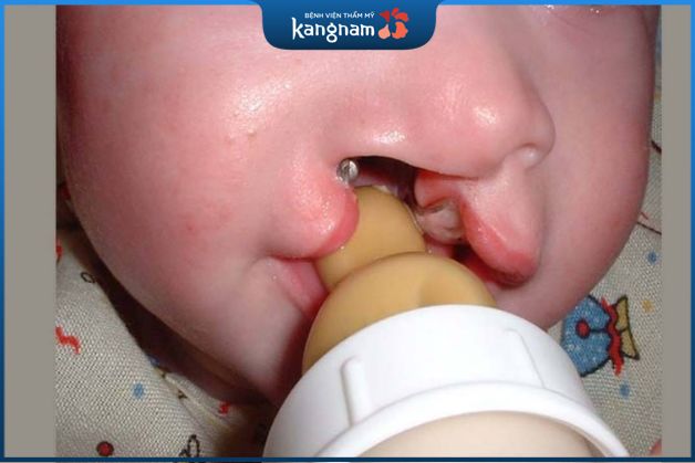 Tuổi tác của bố mẹ quá lớn cũng là một trong những nguy cơ khiến trẻ bị hở hàm ếch.