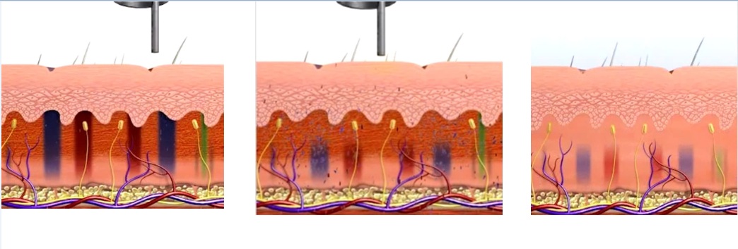 Cơ chế hoạt động thông minh của tia Laser Toning xoa xam vung kin bang laser toning plus