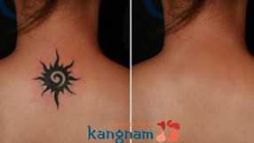 Cách xóa hình xăm bằng laser toning 1 Cách xóa hình xăm bằng laser toning