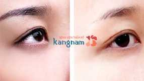 Cách xóa hình xăm an toàn, hiệu quả