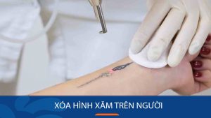 Cách xóa hình xăm trên người hiệu quả, không để lại sẹo