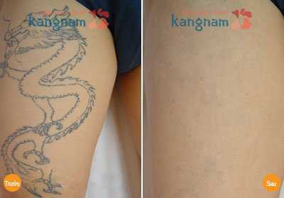 cách xóa hình xăm trên người an toàn, không đau 