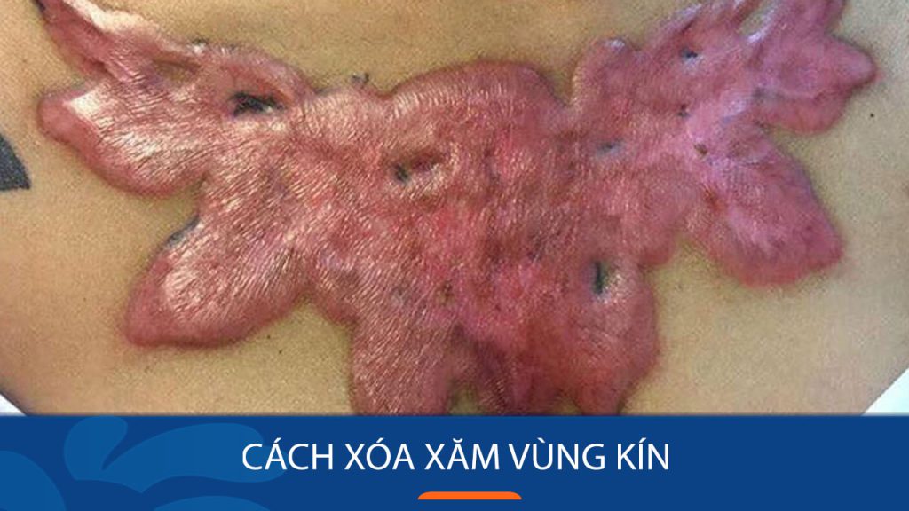 Cách xóa xăm vùng kín hiệu quả an toàn và không để lại sẹo