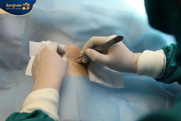 Kỹ thuật căng da vùng nách