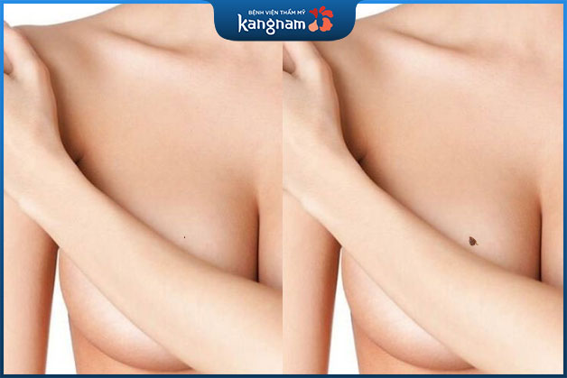 Chỉ trong vòng hơn 1 năm mà kích thước nốt ruồi to lên nhanh chóng