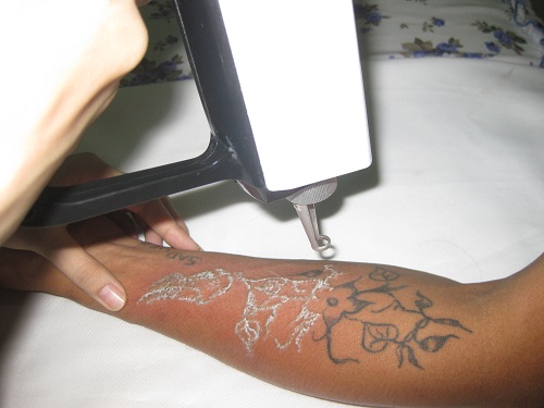 Nguy cơ bỏng rát tới từ những thế hệ Laser cũ