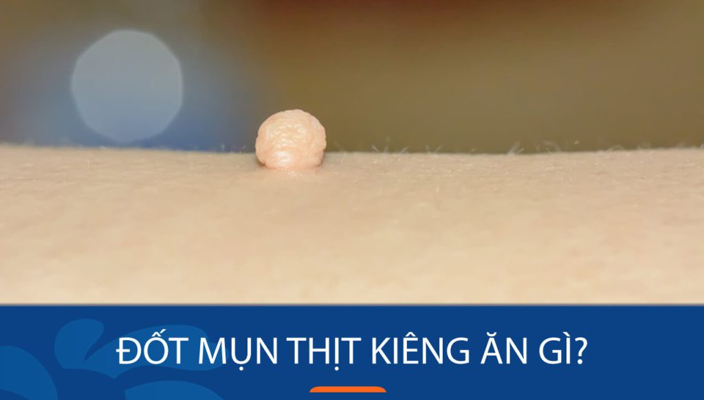 Đốt Mụn Thịt Kiêng Ăn Gì và Nên Ăn Gì Để Phục Hồi Nhanh Chóng?