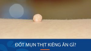 Đốt Mụn Thịt Kiêng Ăn Gì và Nên Ăn Gì Để Phục Hồi Nhanh Chóng?