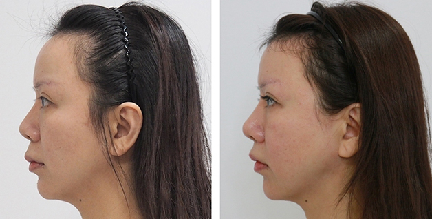 Gọt trán cải thiện trán dô, trán cao mất cân đối