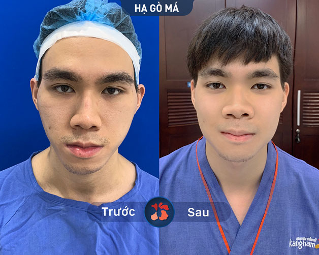 Hạ gò má 6D không lộ sẹo, gương mặt đẹp tự nhiên