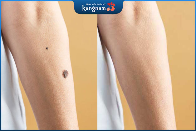 Tẩy nốt ruồi khi nốt mọc to, màu đậm, kém thẩm mỹ