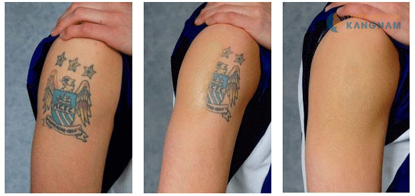 co the xoa xam muc do duoc hay khong4