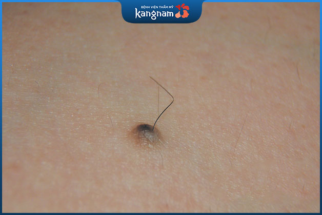 Lông mọc trên nốt ruồi ở cổ ám chỉ đường tình duyên lận đận