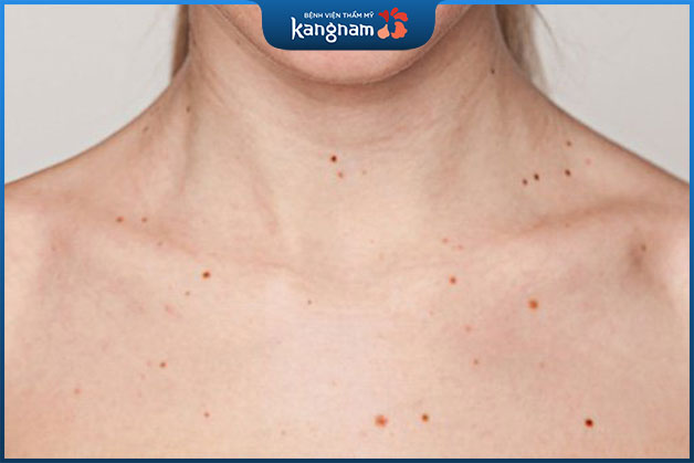 Nốt ruồi mọc quá nhiều ở cổ không phải là vấn đề gì quá nghiêm trọng