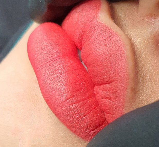 Trong 1 -2 tuần đầu môi vẫn còn sưng