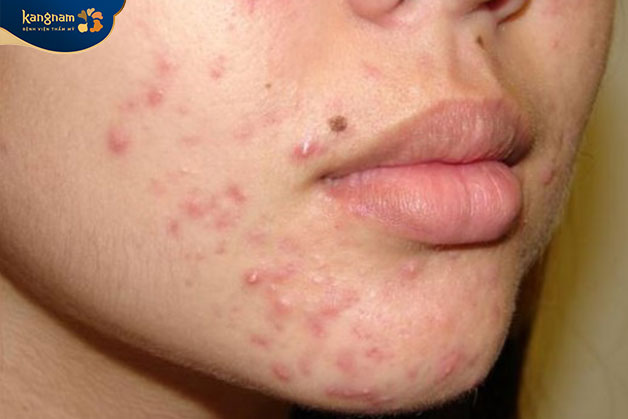 Nhiều trường hợp bị viêm da sau khi triệt râu giá rẻ tại các cơ sở hoạt động chui