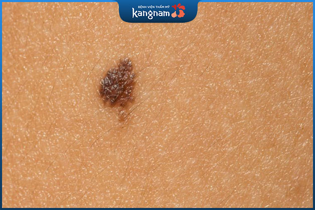 Nốt ruồi màu đen là loại nốt ruồi thường gặp trên cơ thể