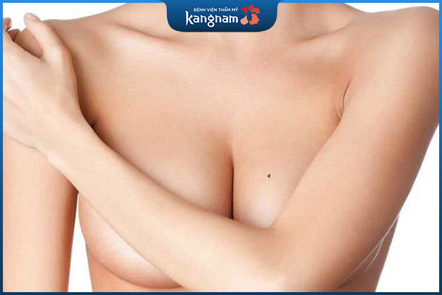 Nốt ruồi nằm trên ngực phải