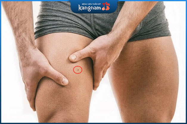 Nốt ruồi ở bắp đùi đàn ông thường dẻo muồm và có chút gian xảo