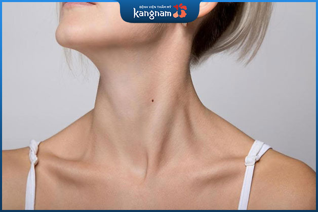 Những người có nốt ruồi ở cổ bên trái hay gặp khó khắn về tài chính