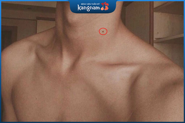 Xem tướng nốt ruồi ở cổ nam giới