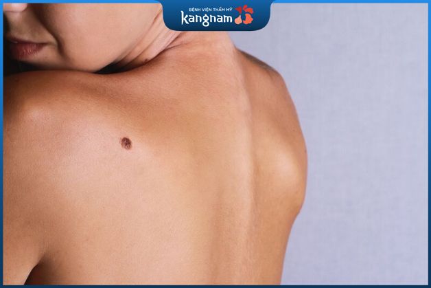 Nốt ruồi tài lộc nằm trên lưng