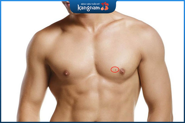 Nốt ruồi ở ngực đàn ông gần nhũ hoa