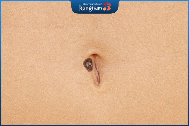 Nốt ruồi phú quý ở rốn