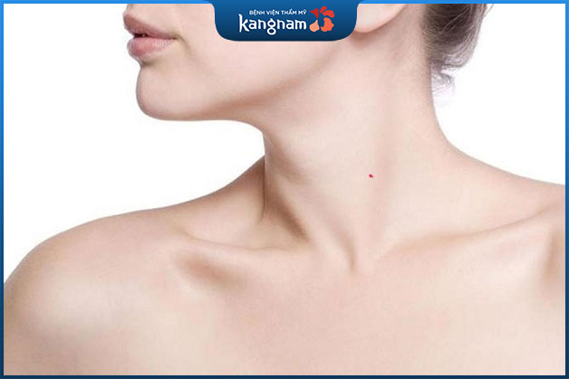 Nốt ruồi son mọc ở cổ là người có tướng số giàu sang