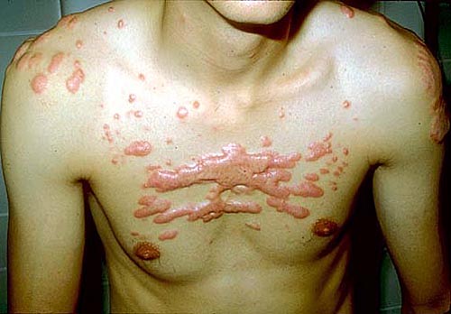 Sẹo lồi để lại do xóa hình xăm thủ công rung minh truoc nhung phuong phap xoa hinh xam thu cong1