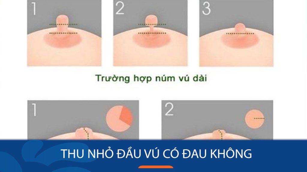 Thu nhỏ đầu vú có đau không: Tìm hiểu về quá trình và cách giảm đau