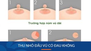 Thu nhỏ đầu vú có đau không: Tìm hiểu về quá trình và cách giảm đau