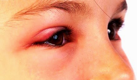 tranh-ton-thuong-khi-xoa-xam-mi-mat-2