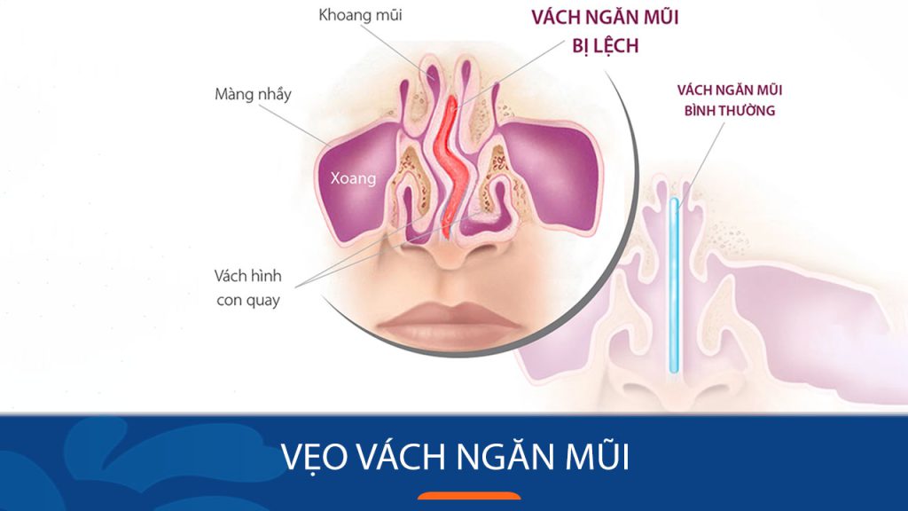 Vẹo vách ngăn mũi là gì? Dấu hiệu, mức độ nguy hiểm và hướng điều trị