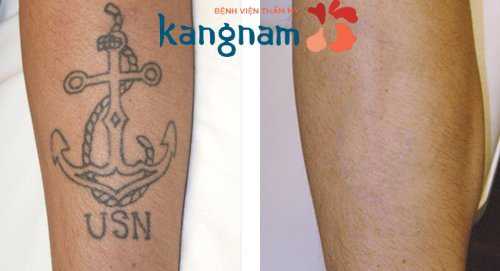 Xóa hình xăm 3d bằng laser toning