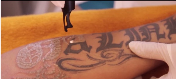 xoa-hinh-xam-co-dau-khong-1