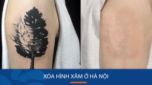 TOP 1 Địa chỉ Xóa hình xăm ở Hà Nội và TpHCM